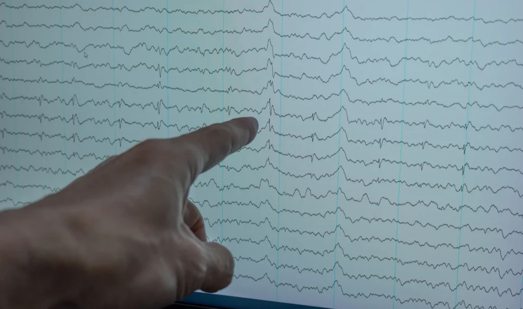 A hand pointing to an EEG monitor displaying the slow spike-and-wave brain pattern that is characteristic of Lennox-Gastaut Syndrome.